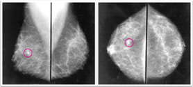 x-ray of breast tissue with pink circles around areas of concern (c) CancerCare Manitoba