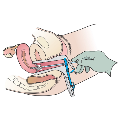 Vue latérale du test Pap avec brosse à prélèvement cervical et spéculum (c) Action CancerCare Manitoba