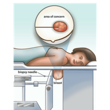 Patient lying face down on exam table with breast compressed, and inset of needle in area of concern (c) Action CancerCare Manitoba