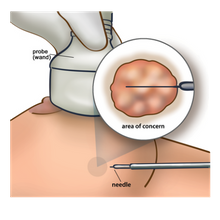 ultrasound wand on breast tissue with needle going into tissue and inset of needle position in area of concern (c) CancerCare Manitoba