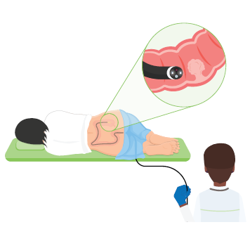 person lying on exam table with healthcare provider doing a colonoscopy (c) CancerCare Manitoba